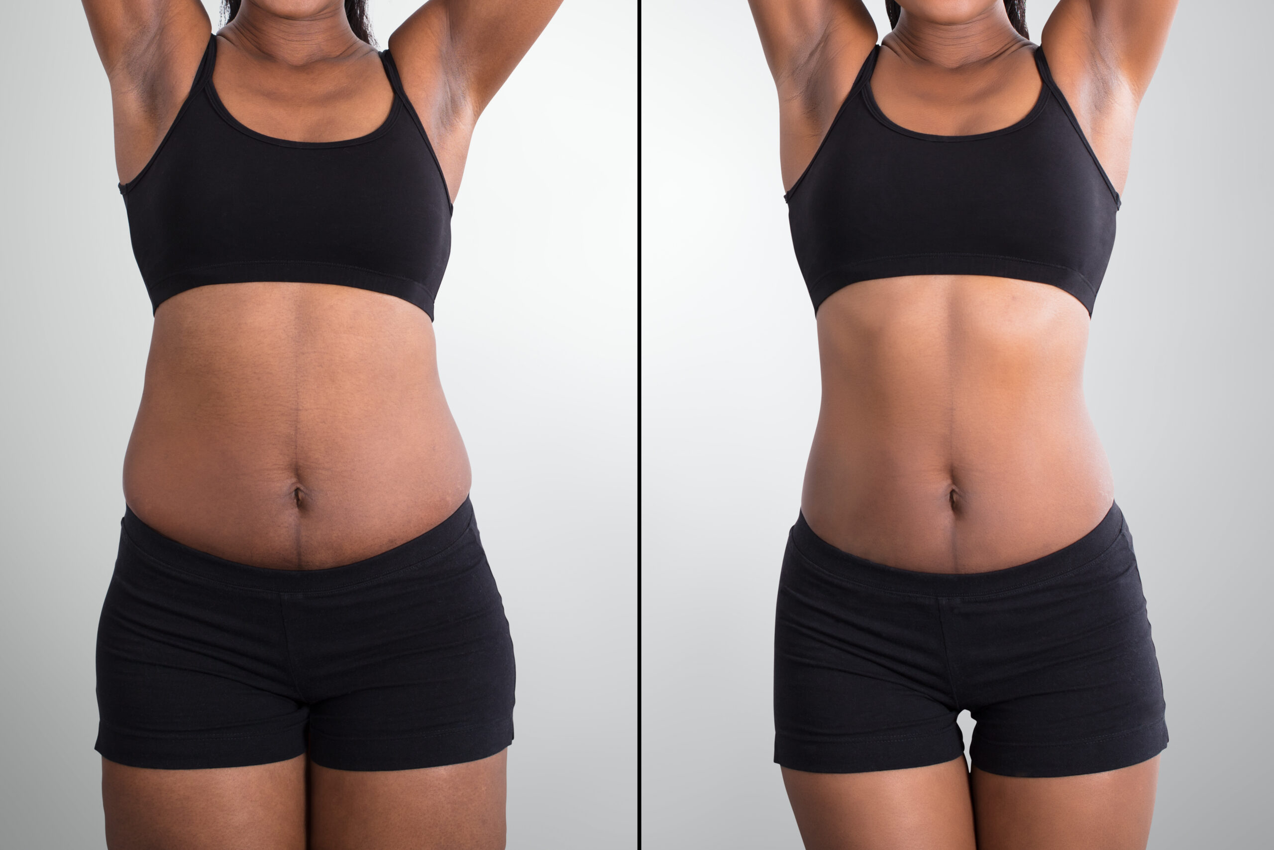 Non Surgical Liposuction In Chandigarh