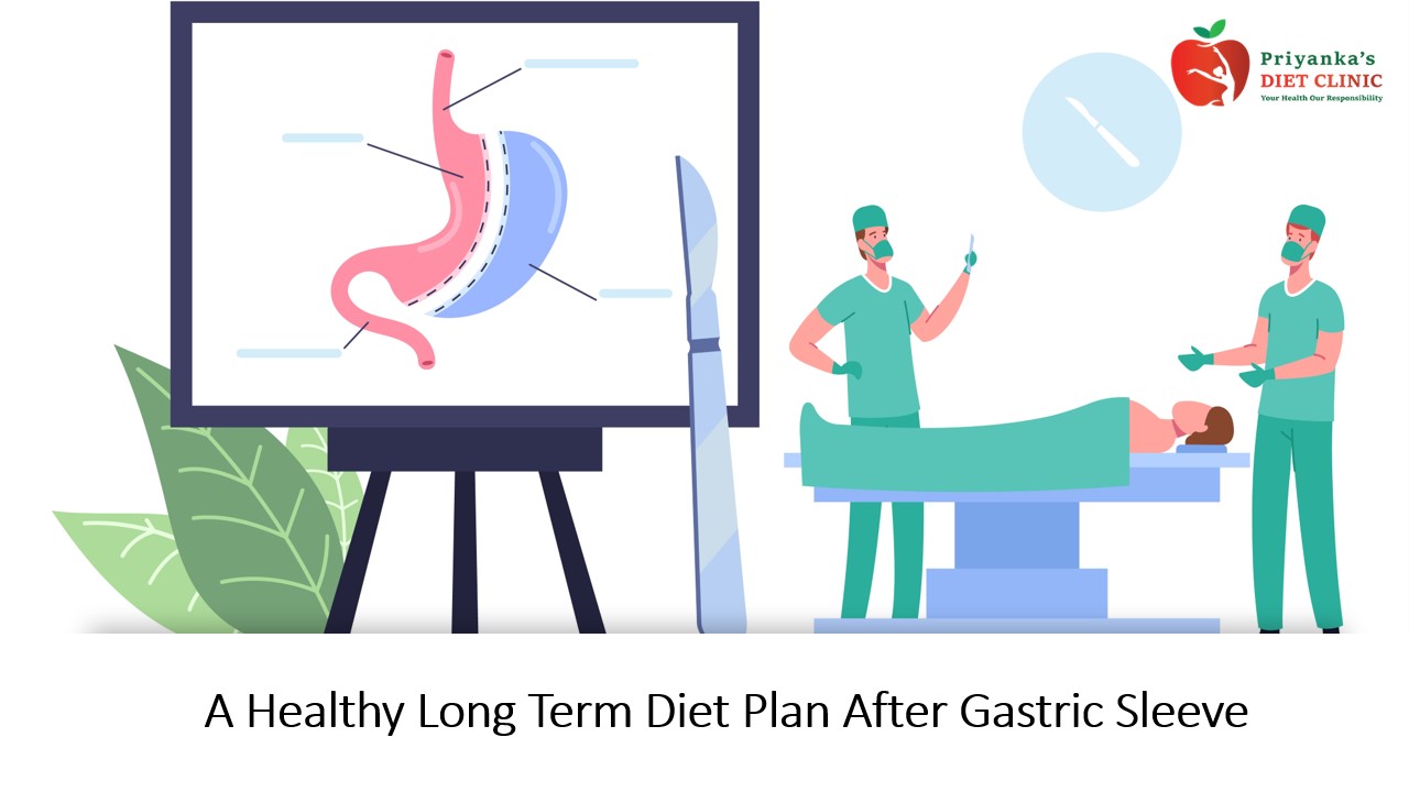 A Healthy Long Term Diet Plan After Gastric Sleeve